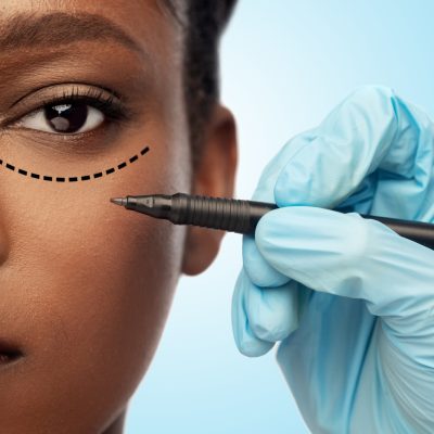 beauty, plastic surgery and people concept - close up of face of beautiful young african american woman with surgical mark under her eye and hand in glove with marker over blue background
